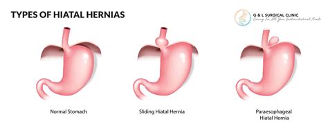 Types Of Hiatal Hernia Surgery