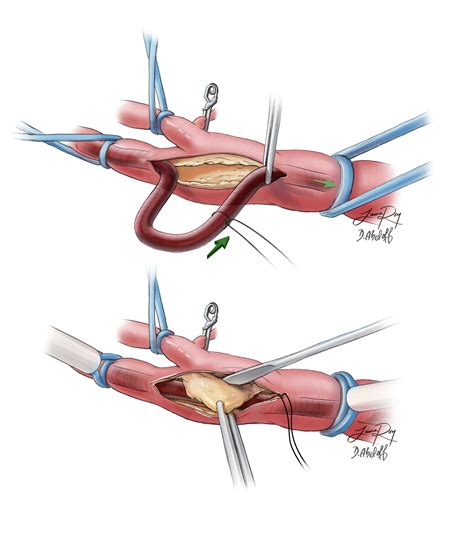 Carotid Endarterectomy Shunt