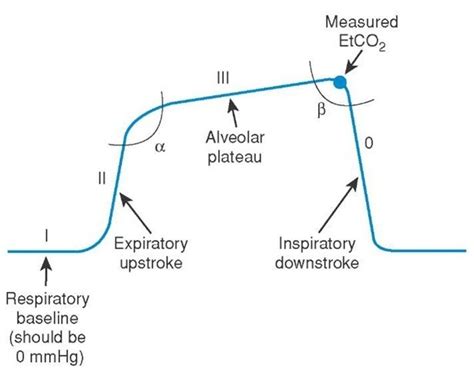 emDOCs.net – Emergency Medicine EducationInterpreting Waveform ...