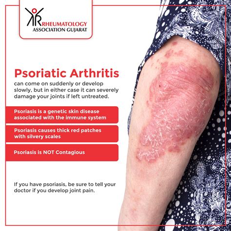 Psoriatic arthritis in 2020 | Psoriatic, Psoriatic arthritis, Psoriasis ...