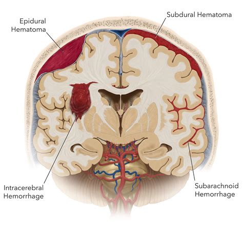 Subarachnoid Hemorrhage | Expert Surgeon | Aaron Cohen-Gadol, MD