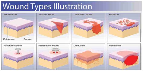 5.1 Lesson: Types of wounds - Siren Training