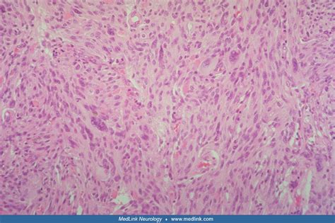 Pleomorphic xanthoastrocytoma | MedLink Neurology