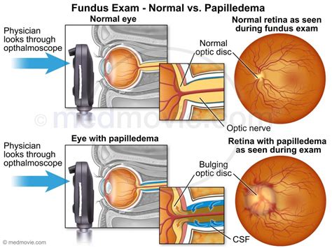 Increased CSF Pressure and Papilledema Findings – Medmovie.com