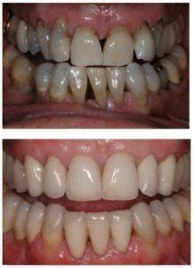 Yellow Teeth - Windsor Centre For Advanced Dentistry