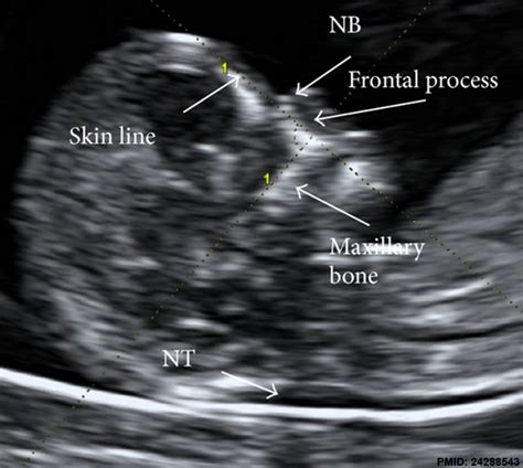 File:Ultrasound nuchal translucency.jpg - Embryology