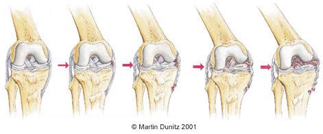 MCL Knee Ligament Injury | PhysioRoom Advice