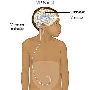 Hydrocephalus - What You Need to Know