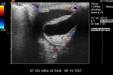 Epididymal cyst - wikidoc