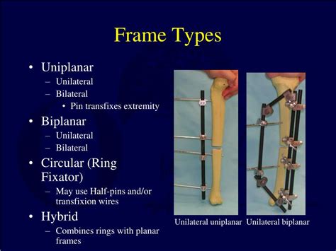 PPT - Principles of External Fixation PowerPoint Presentation, free ...