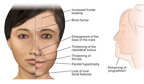 Acromegaly Causes, Symptoms, Diagnosis And Treatment - Natural Health News