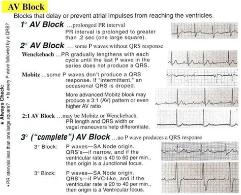 Different Types Of Heart Blocks