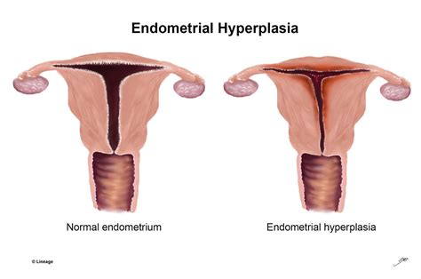 Endometrial Hyperplasia - USMLE Strike