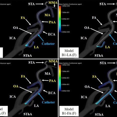 Catheterization method for intra-arterial chemotherapy. Three types of ...