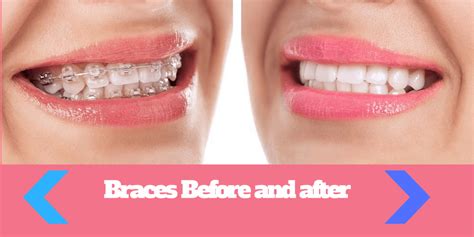 Braces Before and After - 5 FACTS You should know before getting braces ...