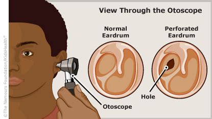 Perforated Eardrum