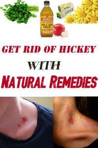 Get Rid of Hickey with Natural Remedies - Crazy Beauty Tricks | Natural ...