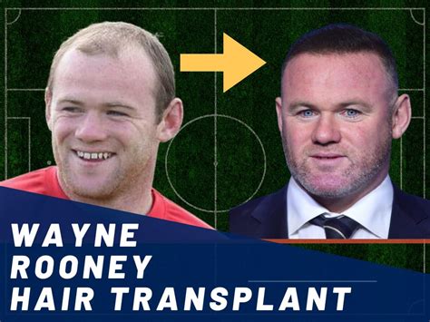 Wayne Rooney Hair Transplant - Hair Loss & Technical Analysis