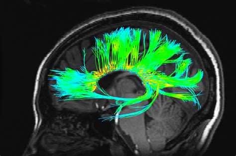 What Is FMRI? - Center for Functional MRI - UC San Diego