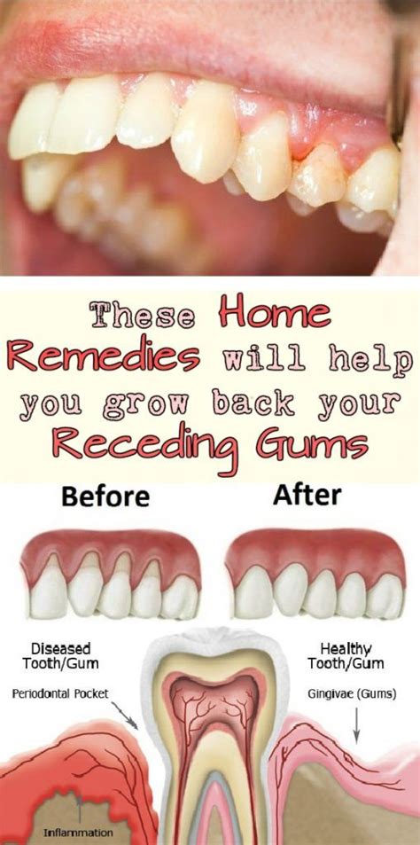 These Home Remedies will help you grow back your Receding Gums ...