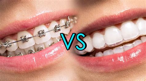 Invisalign Pros and Cons: Could Braces Be a Better Option? – Miosuperhealth