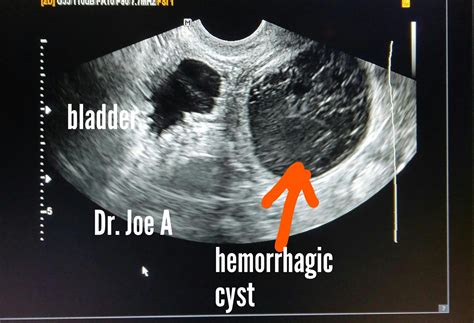 Hemorrhagic Cyst Ultrasound