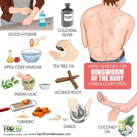 How to Get Rid of Ringworm (of the Body)