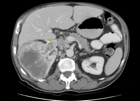 Renal Cell Carcinoma Staging