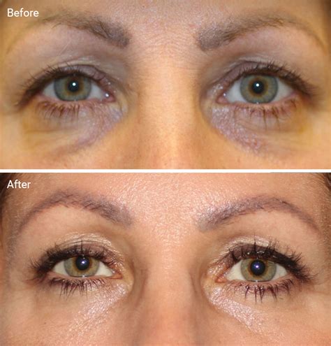 Laser Treatments for Dark Circles: Are They Worth It, Before & Afters, Cost