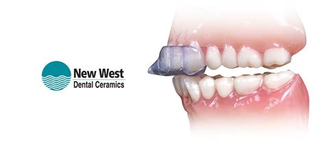 Product Profile: NTI-tss Plus - Dentaltown