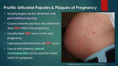 Polymorphic Eruption of Pregnancy (a.k.a. PUPPP) - YouTube