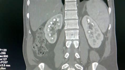 Bilateral symmetrical medullary nephrocalcinosis - YouTube