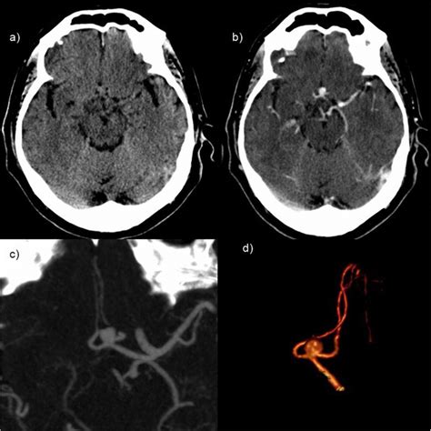 Brain CT of anterior communicating artery aneurysm. Axial unenhanced ...