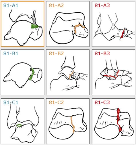 Classification of talus fractures in the SFR. | Download Scientific Diagram