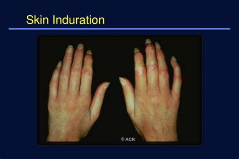 PPT - Scleroderma ( Systemic Sclerosis ) PowerPoint Presentation - ID ...