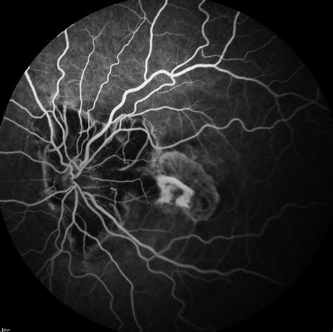 Fluorescein angiography of the left eye 4 years after first ...