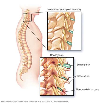 Cervical spondylosis