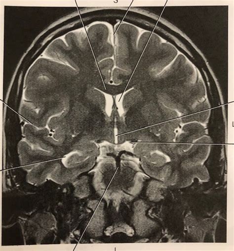 Coronal T2 MRI Temporal Horns Diagram | Quizlet