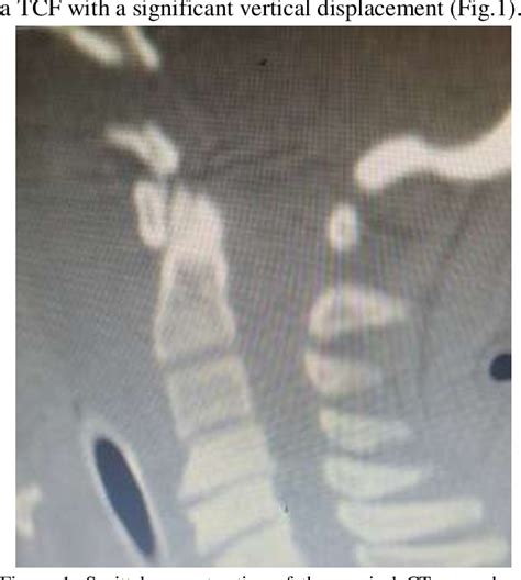 Figure 3 from Transverse Clival Fracture with Vertical Displacement: A ...