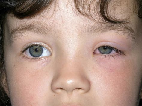 Periorbital cellulitis, Orbital cellulitis, causes, symptoms, diagnosis ...