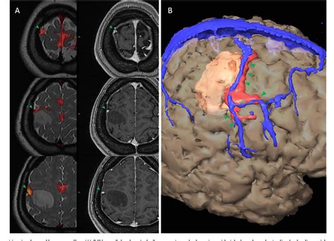 Figure 2 from Challenges and techniques for presurgical brain mapping ...