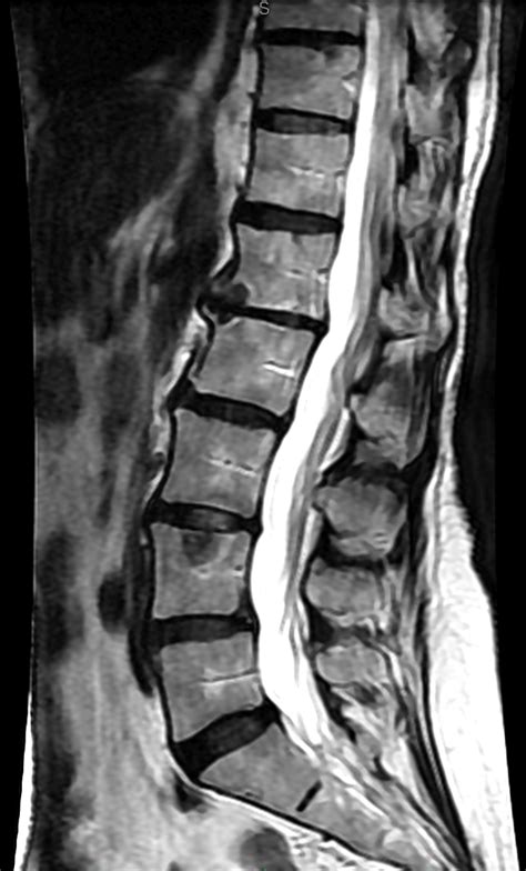 Lumbar Spine Mri Labeled