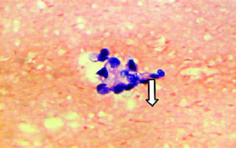 Photomicrograph of cytology specimen showing cellular pleomorphism ...