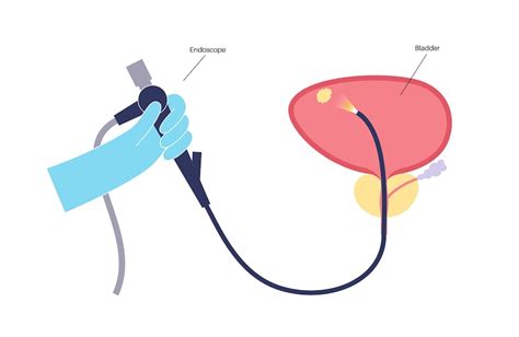 Premium Vector | Cystoscopy is a minimally invasive procedure ...