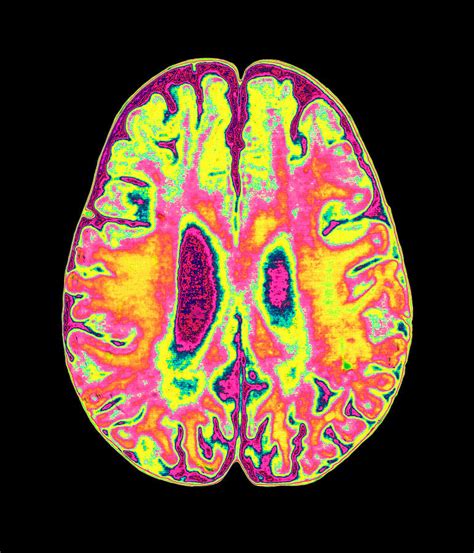 Coloured Mri Scan Of Organophosphate Brain Damage Photograph by Mehau Kulyk