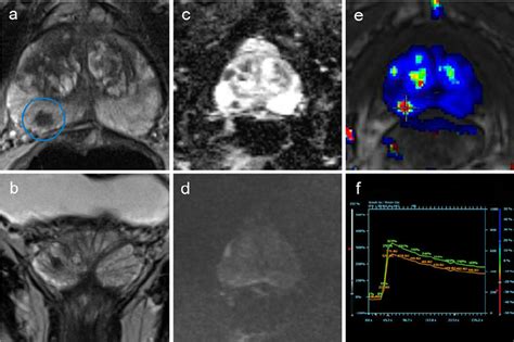 Example of a prostate MRI evaluation. a Axial T2WI with a suspicious ...