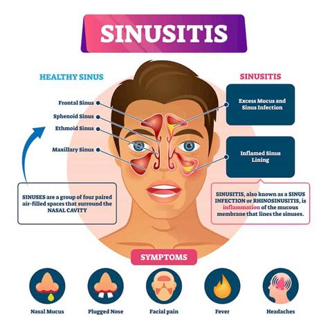 6 Common Symptoms of Chronic Sinusitis To Watch Out For