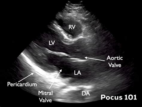 Measuring Cardiac Output with Echocardiography Made Easy - POCUS 101 (2024)