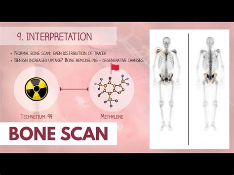 Bone Scan Procedure: A Comprehensive Guide | SchoolTube