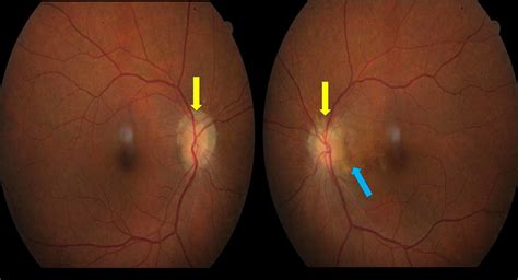 Optic Disc Drusen